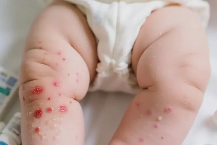 嬰幼兒大腿上長(zhǎng)濕疹能徹底自愈嗎(圖3)