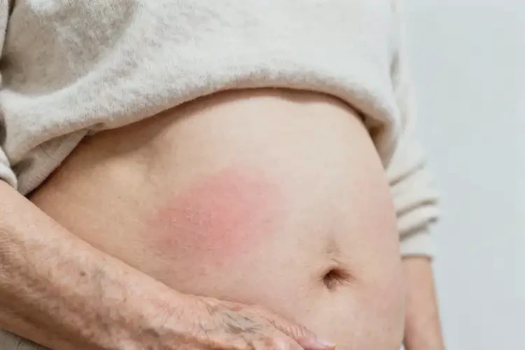 老年人肚子長濕疹不管它會自己自愈嗎(圖3)