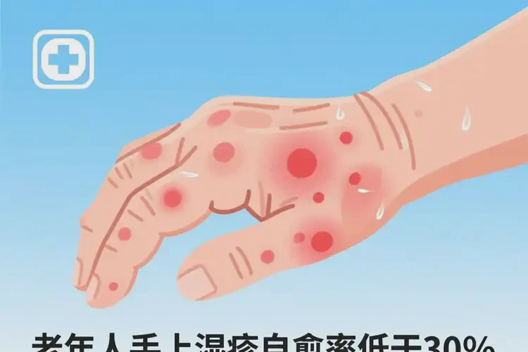 老年人手上經(jīng)常長(zhǎng)濕疹不管它會(huì)自己自愈嗎(圖2)