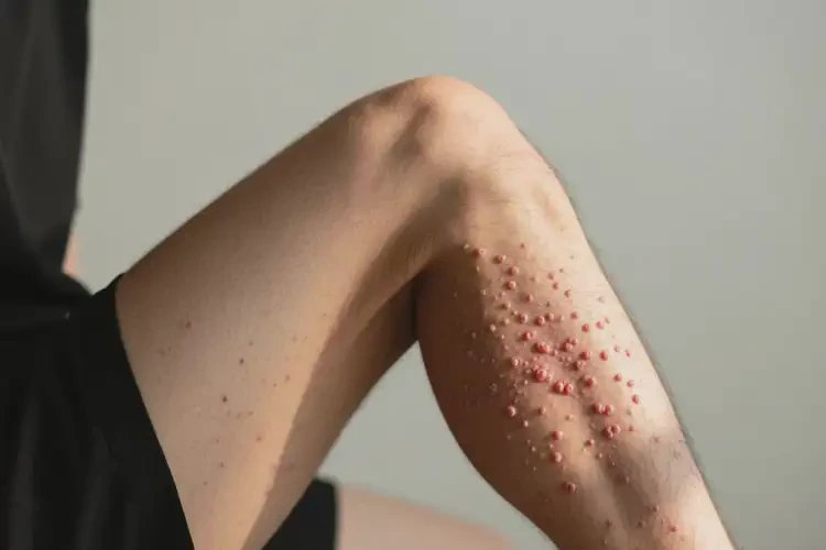 男人大腿長濕疹不管它會自己痊愈嗎(圖3)