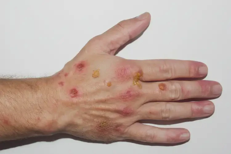 青年人手上出現(xiàn)濕疹不管它會自己痊愈嗎(圖2)