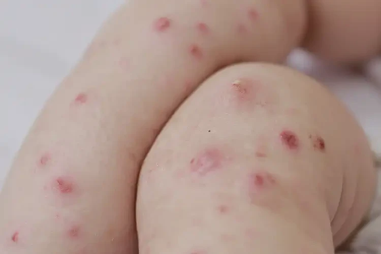 嬰兒四肢出現(xiàn)濕疹能徹底自愈嗎(圖4)