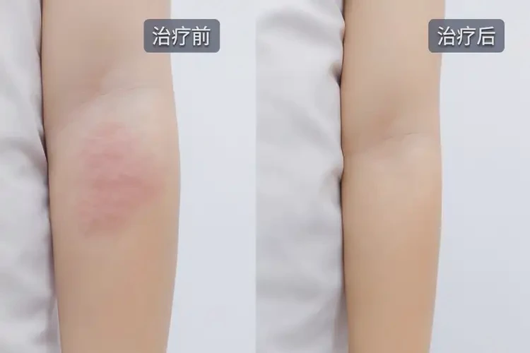 小孩手臂经常长湿疹能够彻底治愈吗(图4)