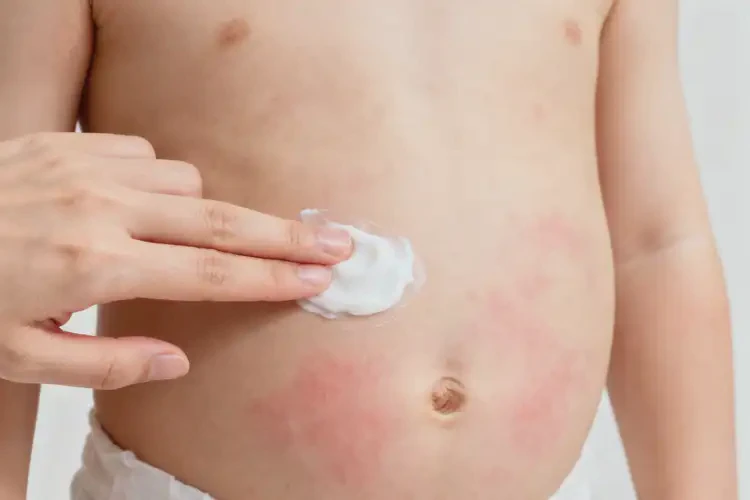 孩子肚子上有濕疹不管它會自己好嗎(圖3)