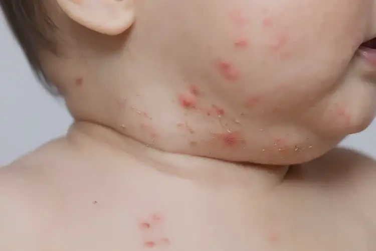 嬰幼兒脖子經(jīng)常起濕疹不管它會自己自愈嗎(圖4)