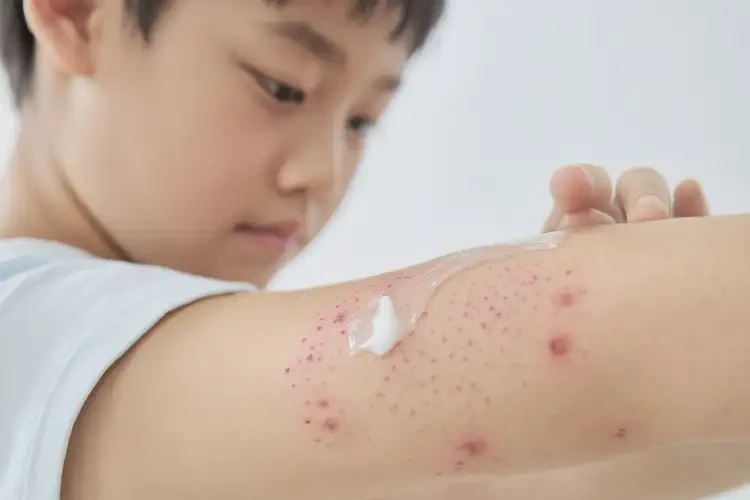 青少年四肢長濕疹不管它會自己自愈嗎(圖3)