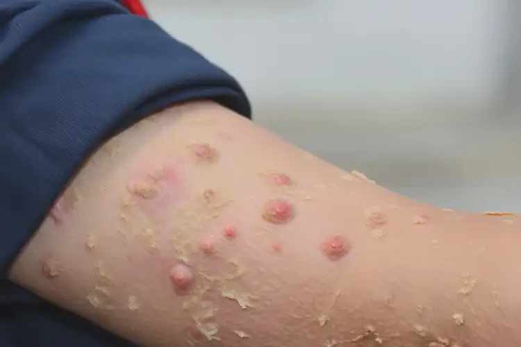 中學生手臂上長濕疹能夠徹底治愈嗎(圖4)