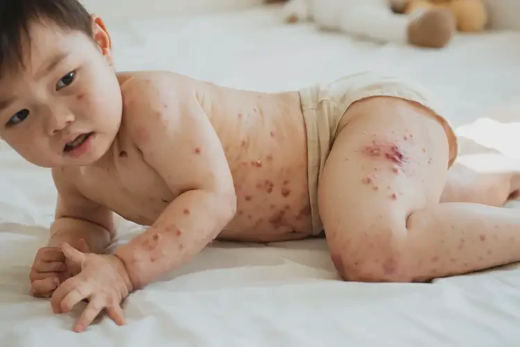 幼兒肚子上出現(xiàn)濕疹能不能徹底自愈(圖3)