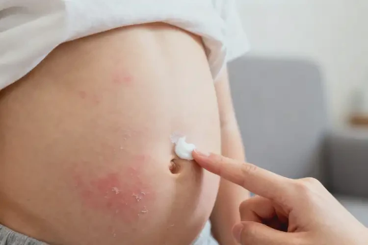 少兒肚子上偶爾長(zhǎng)濕疹不管它會(huì)自己自愈嗎(圖2)