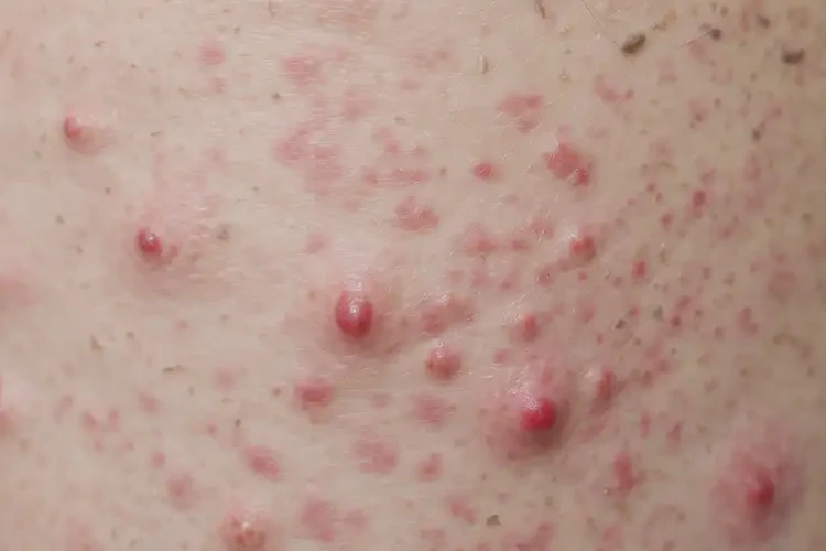 女生手臂出湿疹可以彻底自愈吗(图4)