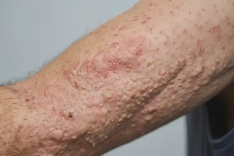 男生脖子偶爾起濕疹不管它會自己好嗎(圖2)