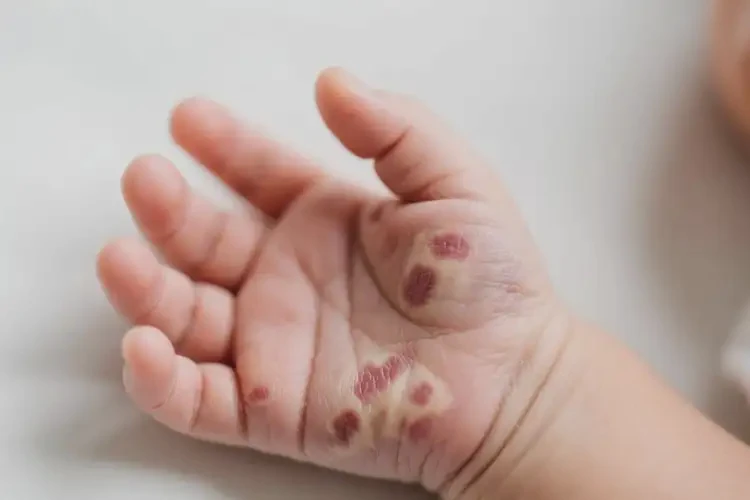 新生兒手上出現(xiàn)濕疹可以徹底自愈嗎(圖4)