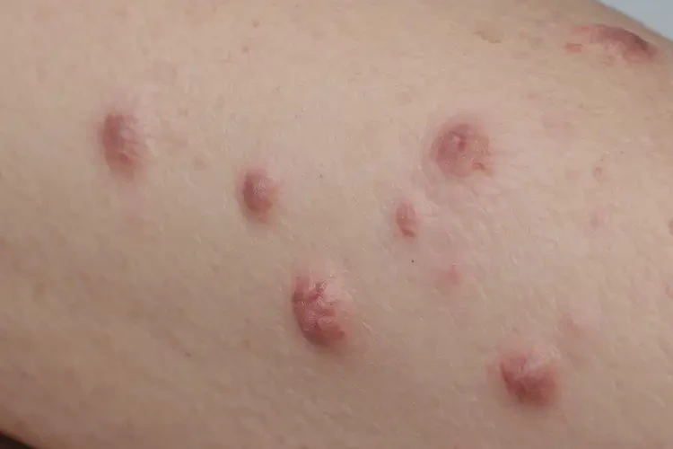 青少年小腿經常長濕疹能夠徹底治愈嗎(圖4)