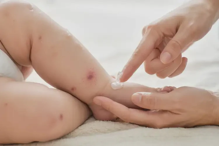 嬰幼兒屁股容易起濕疹不管它會(huì)自己自愈嗎(圖2)