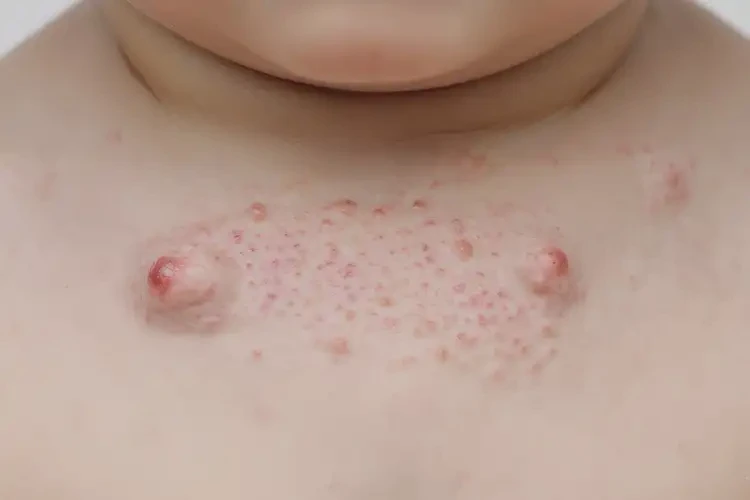 小孩脖子上偶爾長(zhǎng)濕疹能夠徹底治愈嗎(圖4)