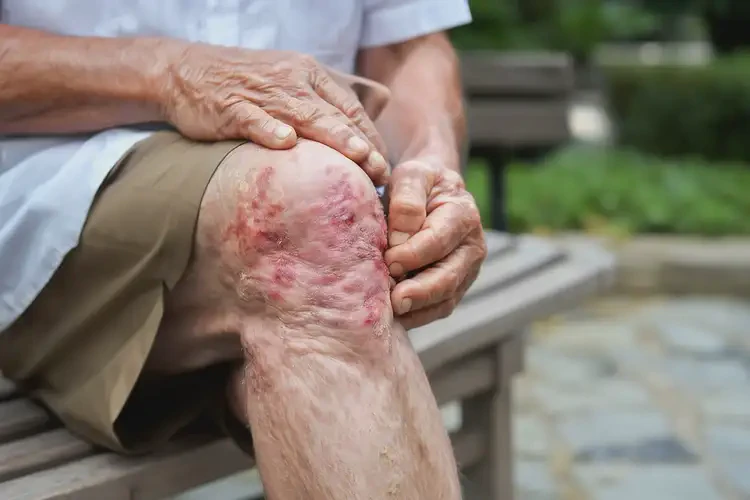 老年人大腿經(jīng)常起濕疹能靠自己自愈嗎(圖4)