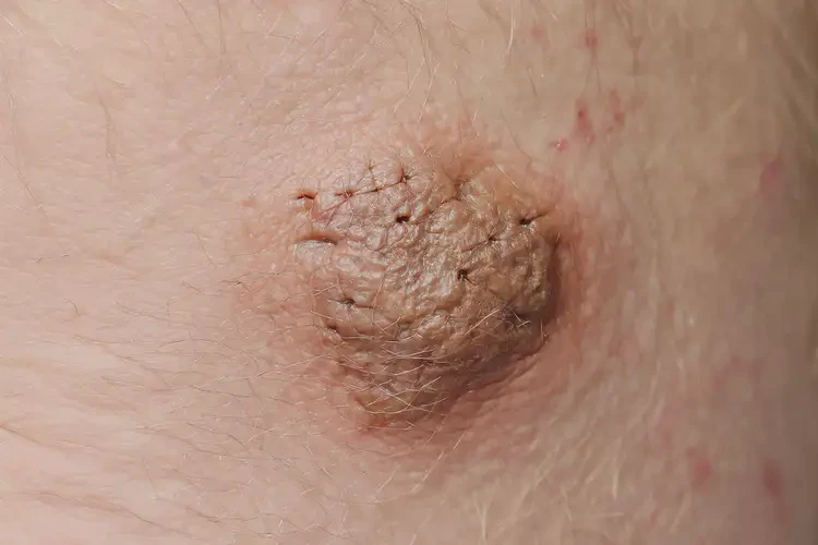 男人手臂上出濕疹能徹底自愈嗎(圖3)