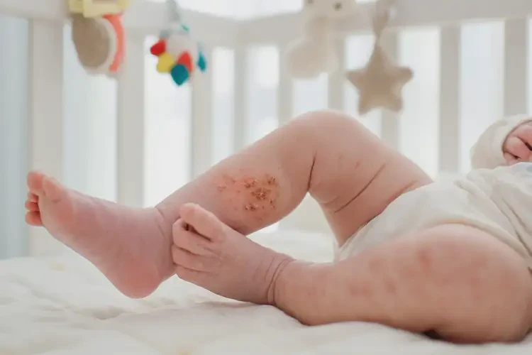 新生兒小腿上偶爾長(zhǎng)濕疹不管它會(huì)自己好嗎(圖4)