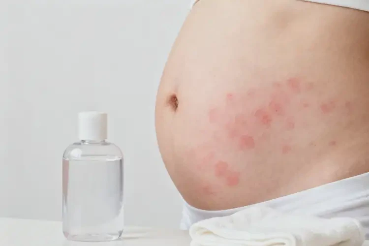 女性肚子上出現(xiàn)濕疹能徹底自愈嗎(圖1)