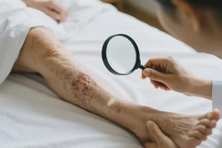 老年人四肢容易起濕疹不管它會(huì)自己痊愈嗎(圖1)