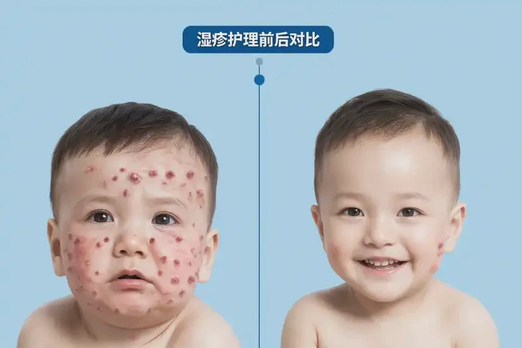 少兒屁股上容易長濕疹可不可以徹底自愈(圖1)