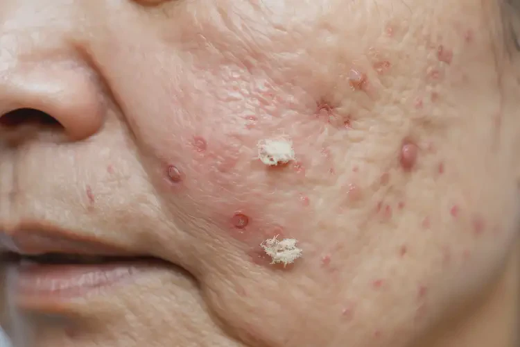 小學(xué)生手臂上出濕疹能徹底自愈嗎(圖3)