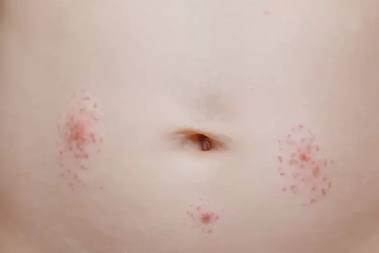 新生儿肚子经常起湿疹可以彻底自愈吗(图4)