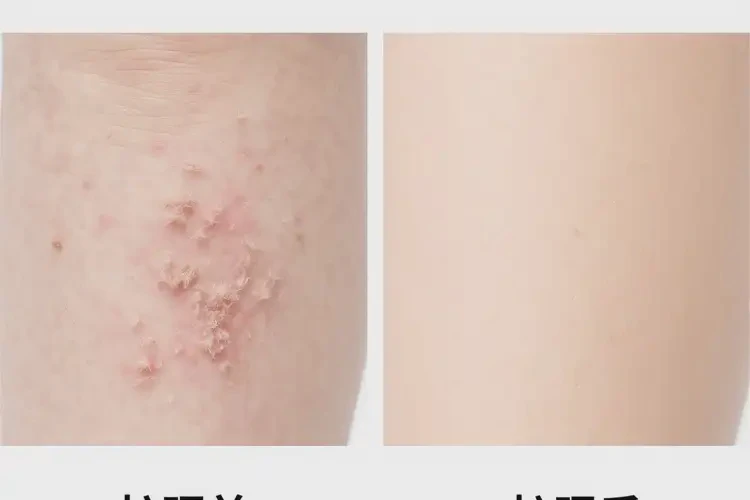 幼兒小腿上偶爾長濕疹可不可以徹底自愈(圖2)