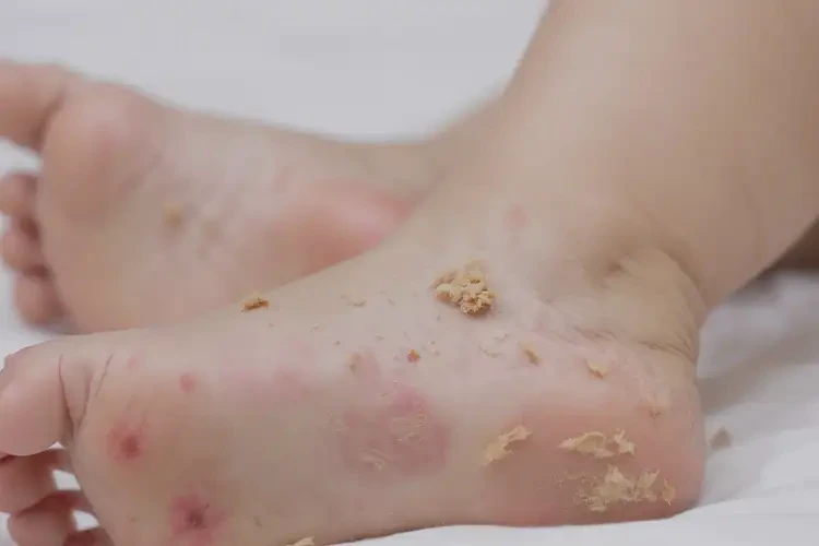 兒童腳上出濕疹不管它會自己好嗎(圖4)