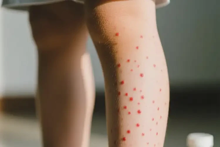 小儿小腿偶尔长湿疹不管它会自己痊愈吗(图1)