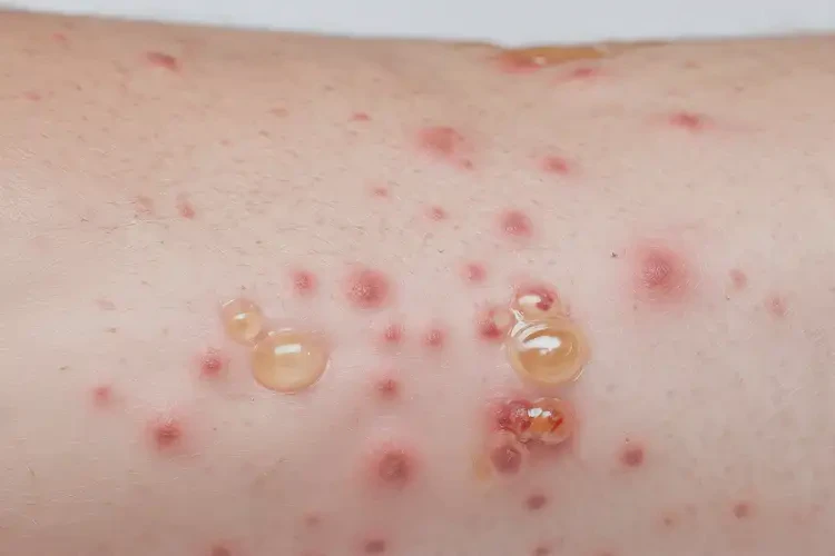 女人脸上偶尔起湿疹不管它会自己痊愈吗(图4)