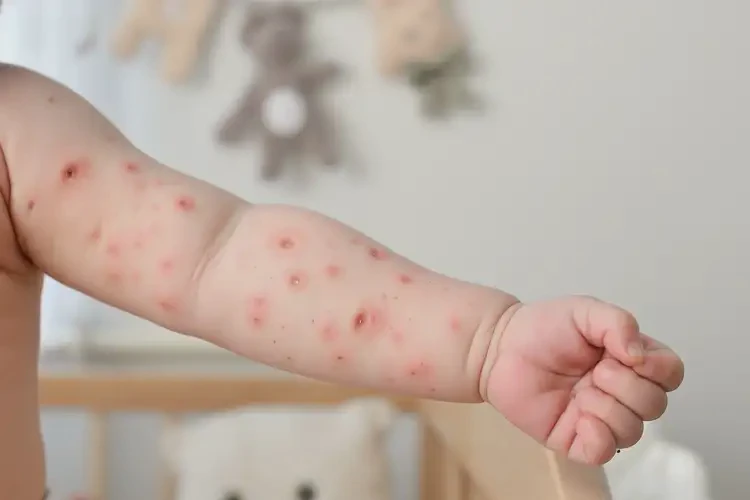新生兒手臂上容易起濕疹能夠徹底治愈嗎(圖4)