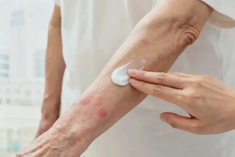 高齡老人手臂偶爾長濕疹不管它會(huì)自己好嗎(圖3)