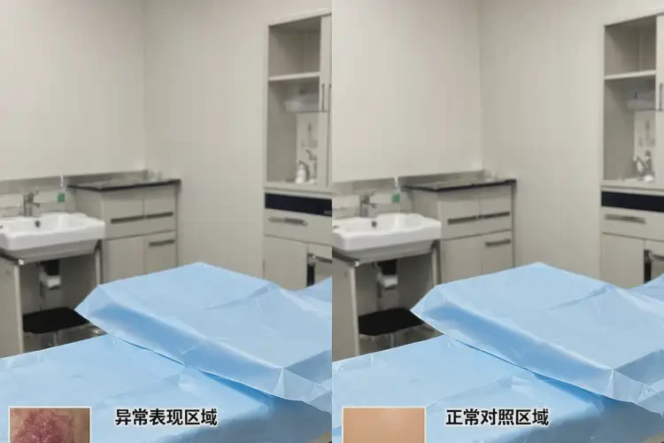 哺乳期媽媽肛周起濕疹不管它會自己痊愈嗎(圖2)