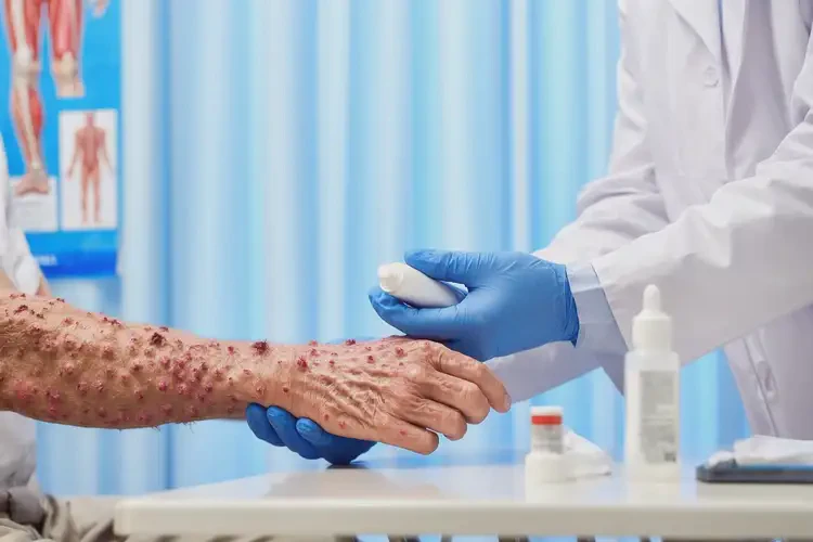 老年人身上長濕疹能徹底自愈嗎(圖3)