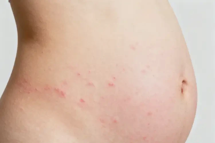 女生肚子上偶爾長濕疹能徹底自愈嗎(圖3)