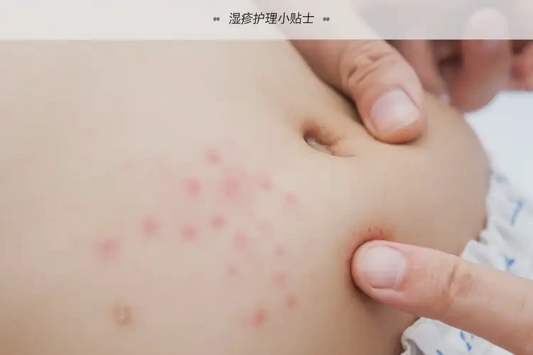 兒童肚子上起濕疹能靠自己自愈嗎(圖4)