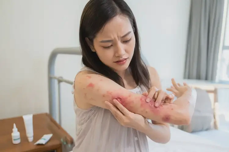 產(chǎn)婦手臂上經(jīng)常起濕疹不管它會(huì)自己好嗎(圖4)