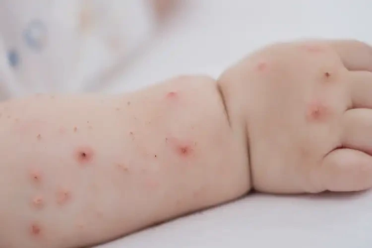 寶寶手臂出現(xiàn)濕疹不管它會(huì)自己痊愈嗎(圖4)
