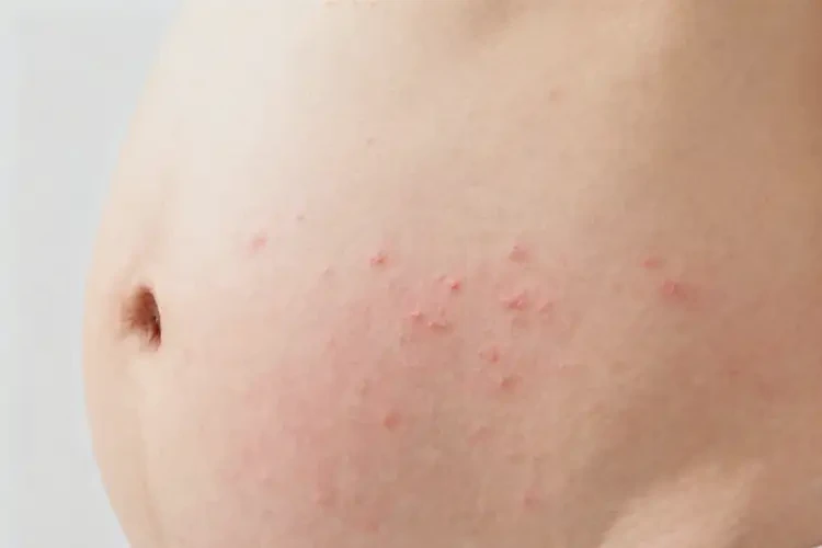 女生肚子上偶爾長濕疹能徹底自愈嗎(圖2)
