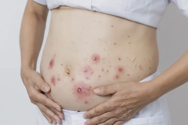 女生肚子有濕疹能靠自己自愈嗎(圖4)