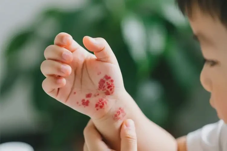 小孩全身經(jīng)常長濕疹能靠自己自愈嗎(圖3)