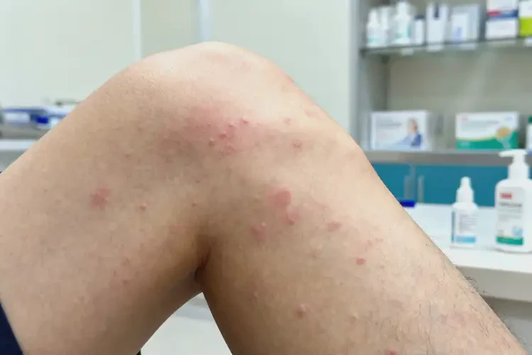 青年人大腿上容易長(zhǎng)濕疹能徹底自愈嗎(圖1)