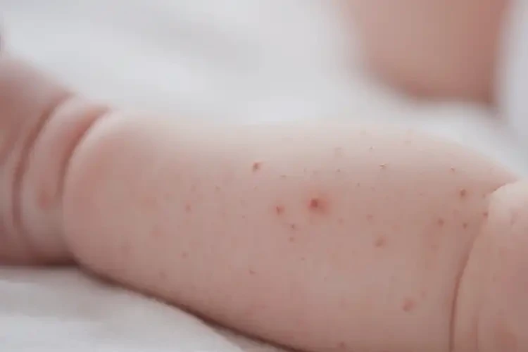 新生兒四肢出現(xiàn)濕疹不管它會(huì)自己好嗎(圖4)