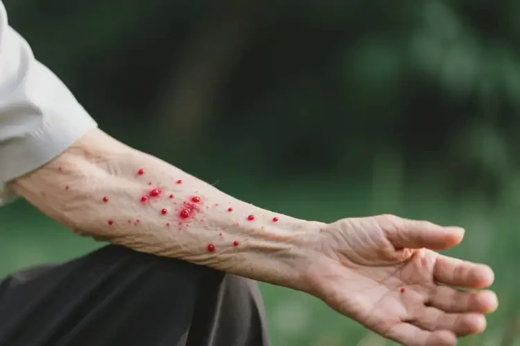 老人身上有濕疹能徹底自愈嗎(圖1)