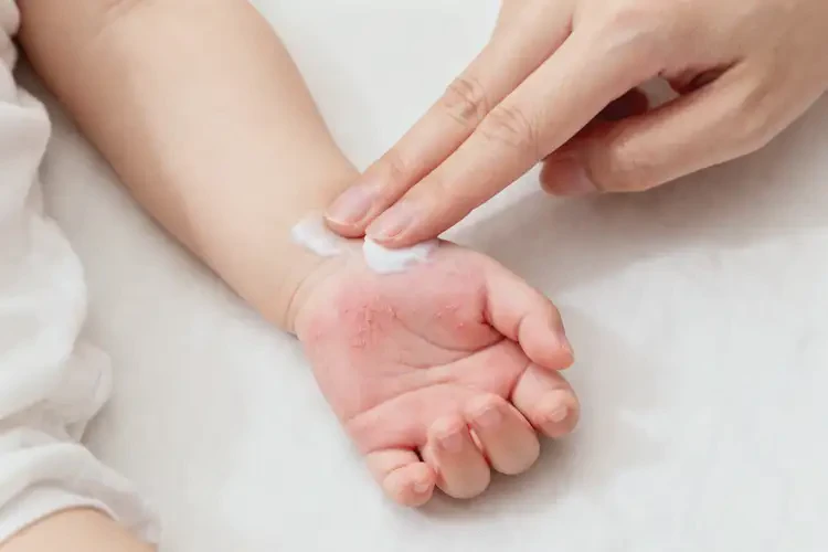 嬰幼兒手上偶爾長濕疹能夠徹底治愈嗎(圖1)