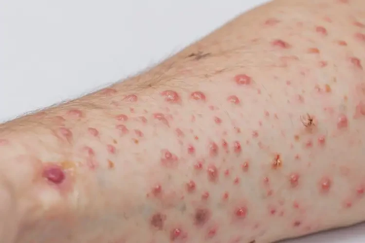 女生手臂上偶爾長濕疹可不可以徹底自愈(圖4)