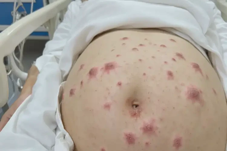 產(chǎn)婦肚子經(jīng)常長(zhǎng)濕疹可不可以徹底自愈(圖4)