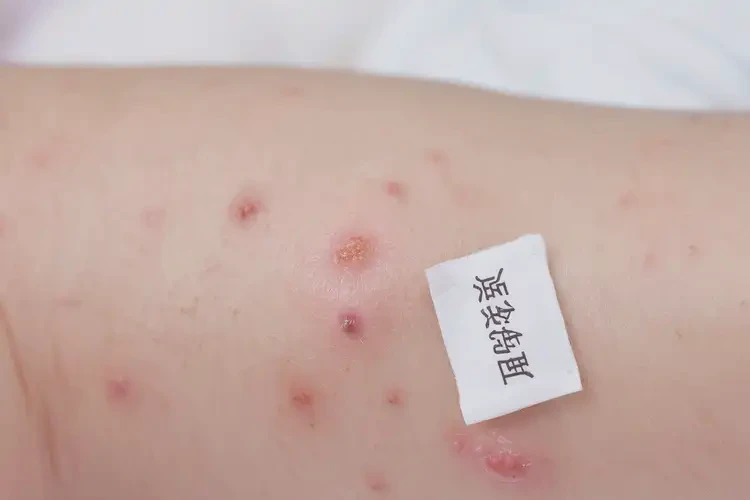 寶寶四肢長濕疹可以徹底自愈嗎(圖4)