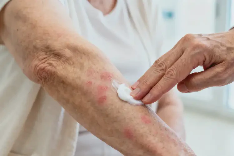 高齡老人手臂偶爾長濕疹不管它會(huì)自己好嗎(圖1)